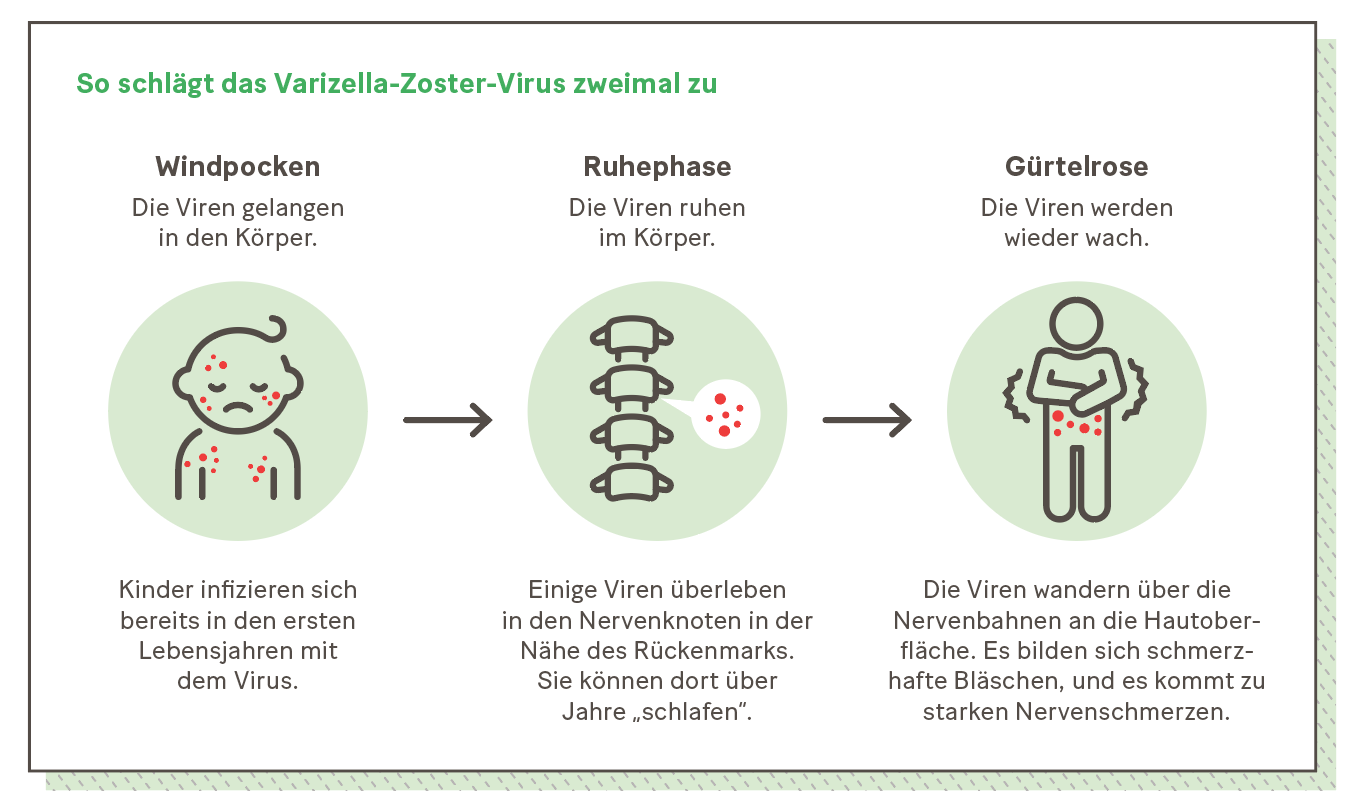 Grafik: So schlägt das Varizella-Zoster-Virus zweimal zu